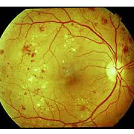Image showing moderate diabetic retinopathy