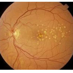 Image showing the effects of early AMD